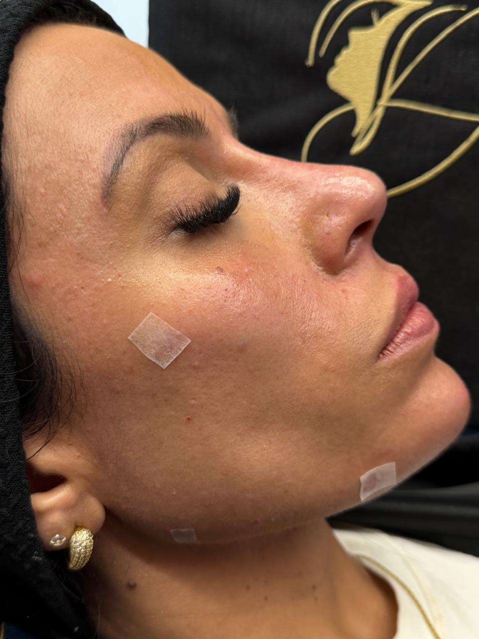 Paciente 1 - Rejuvenescimento Facial — depois