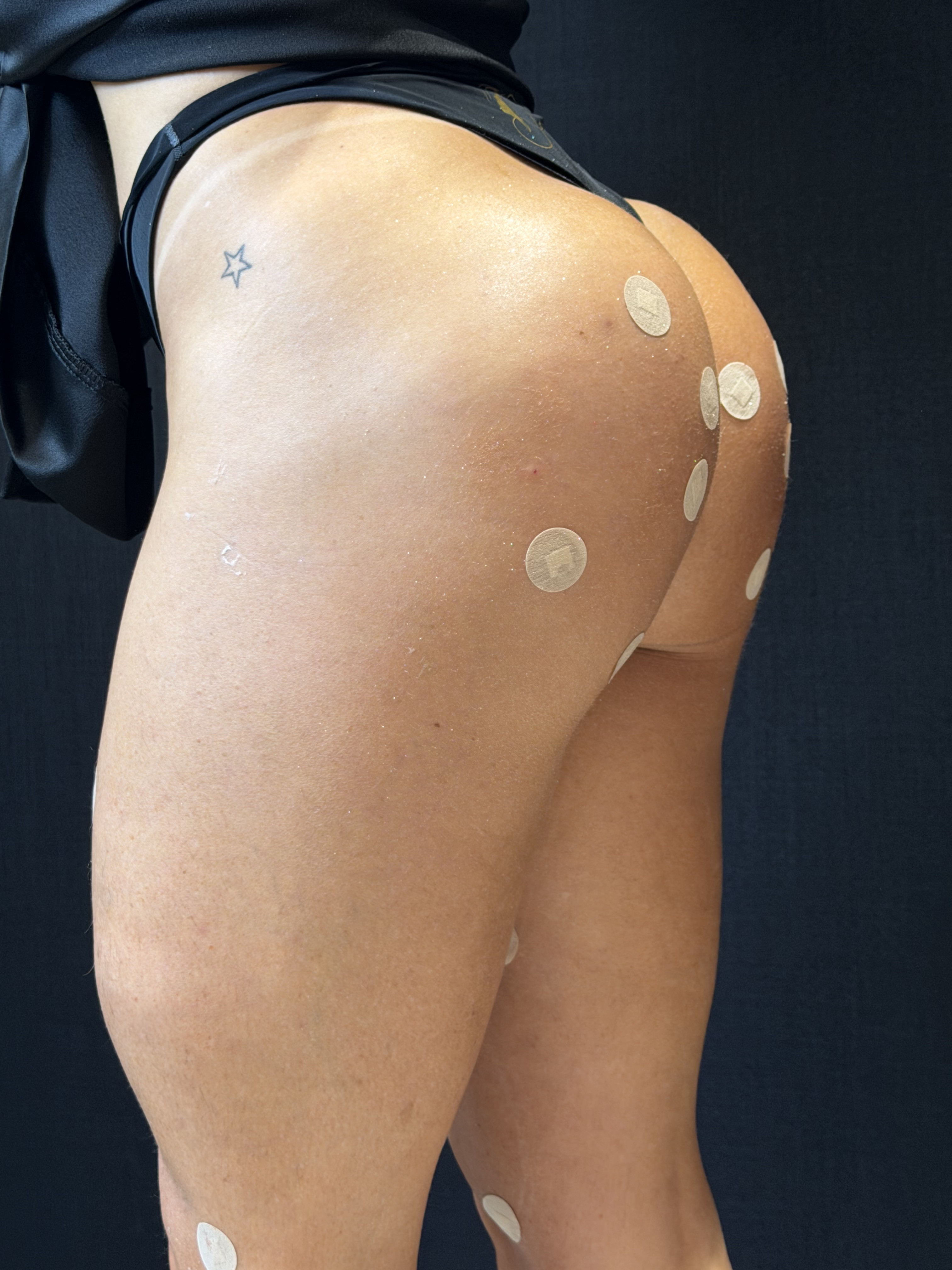 Paciente 3 - Contorno Corporal — depois