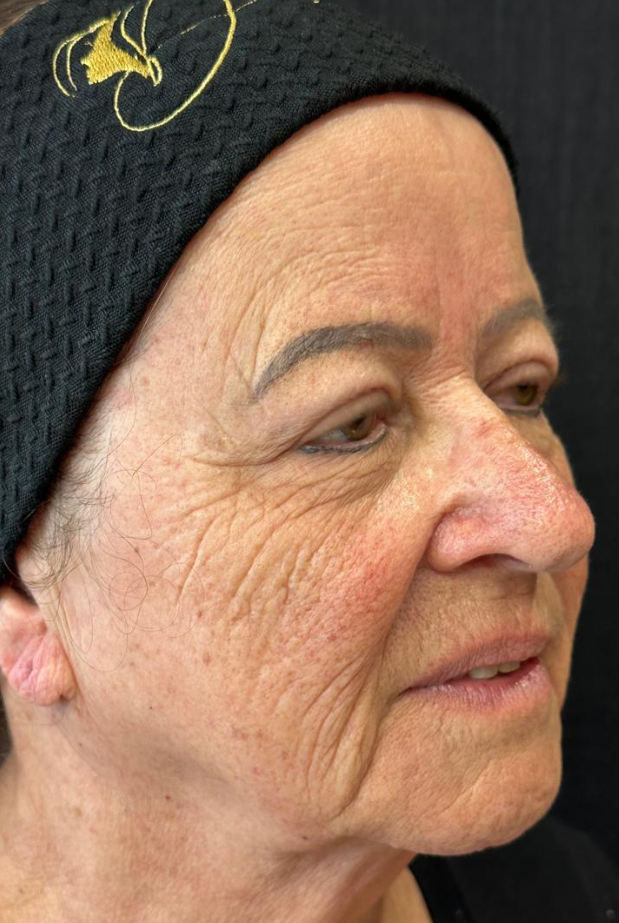 Paciente 4 - Harmonização Facial — antes